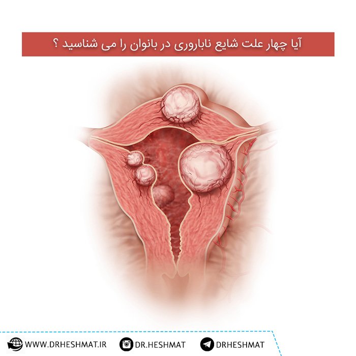 چهار علت شایع ناباروری در خانم ها ناباروری زنان
