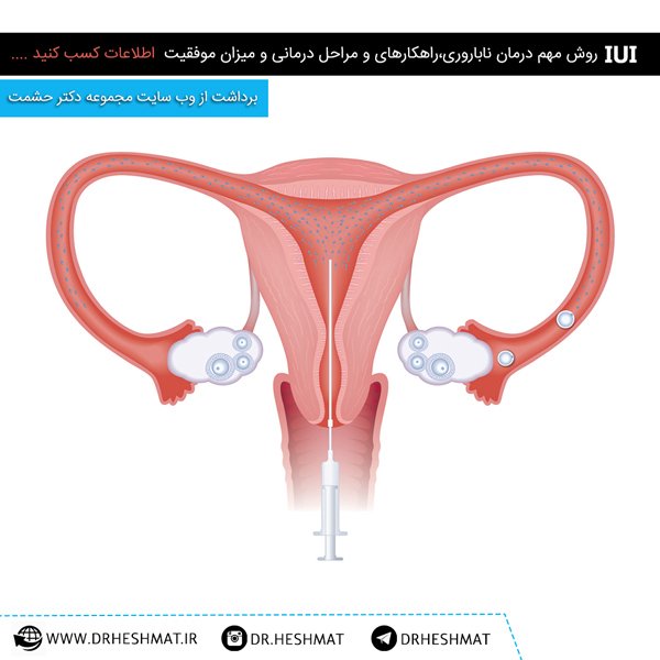 تزریق-اسپرم-داخل-رحم IUI آی یو آِی