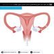 IUI آی یو آِی