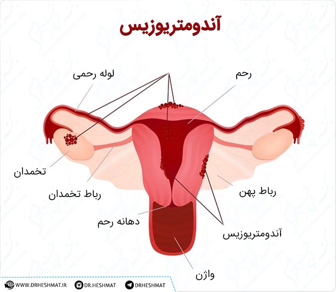 Endometriosis درمان نازایی